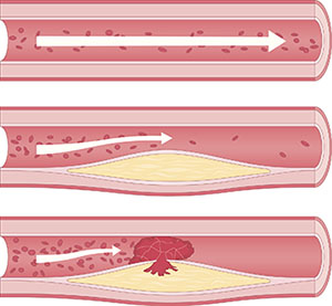 Atherosclerosis diagram